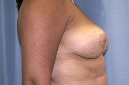 Breast Reduction Before and After 05