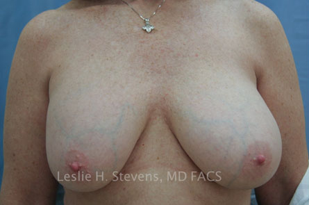 Breast Reduction Before and After 08