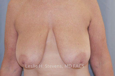 Breast Reduction Before and After | Dr. Leslie Stevens