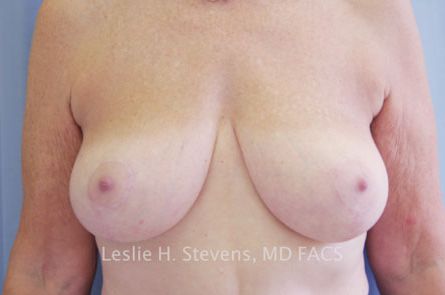 Breast Reduction Before and After 13