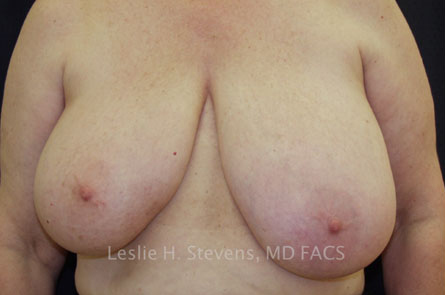 Breast Reduction Before and After | Dr. Leslie Stevens