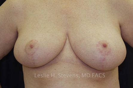 Breast Reduction Before and After 15