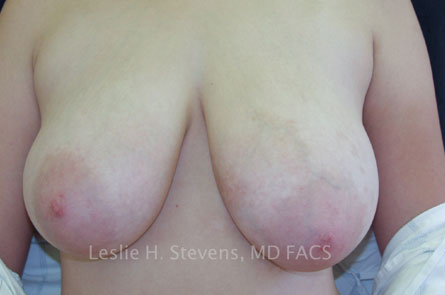 Breast Reduction Before and After 11