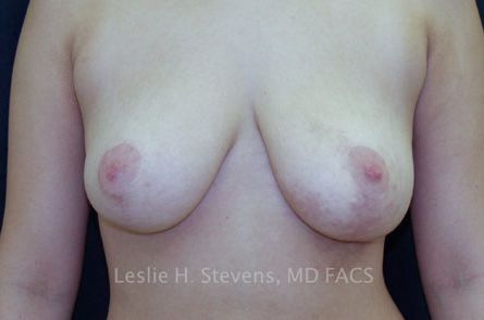 Breast Reduction Before and After | Dr. Leslie Stevens