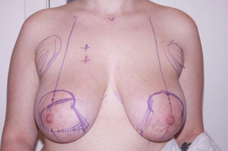 Breast Reduction Before and After | Dr. Leslie Stevens