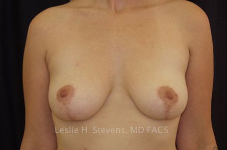 Breast Reduction Before and After 03