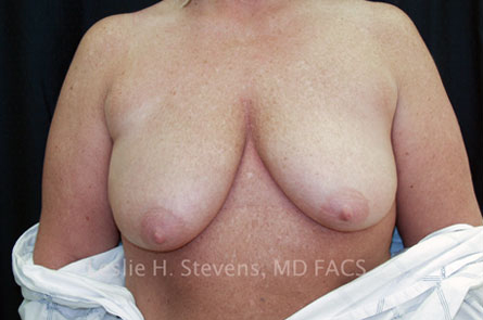 Breast Reduction Before and After 13