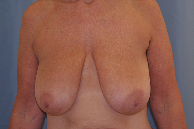 Breast Reduction Before and After | Dr. Leslie Stevens