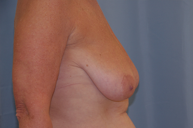Breast Reduction Before and After 16