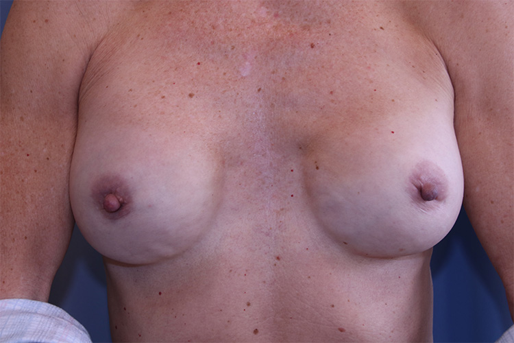 Breast Revision Before and After | Dr. Leslie Stevens