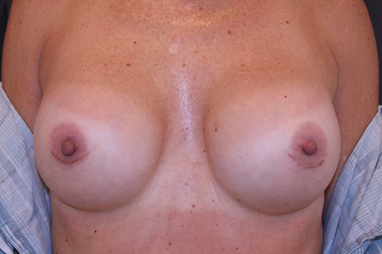 Breast Revision Before and After | Dr. Leslie Stevens