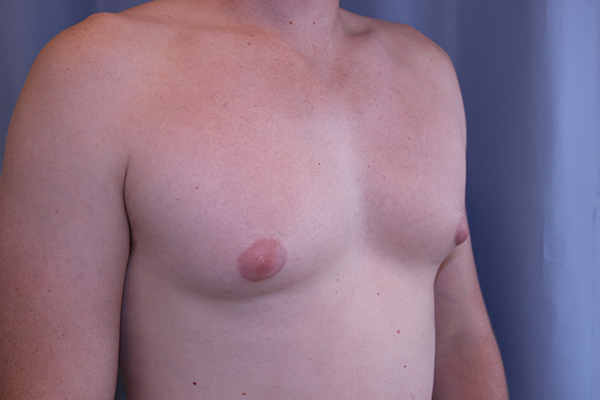 Gynecomastia Before and After 01