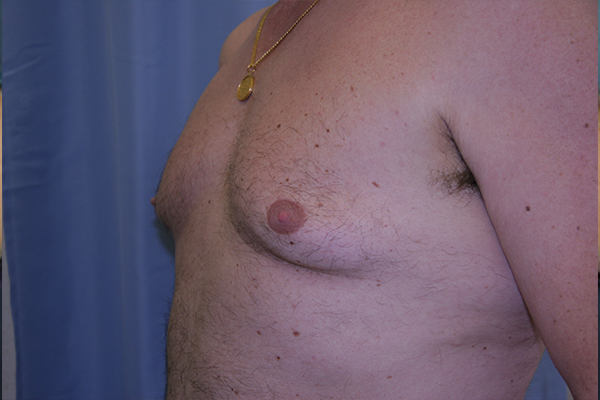Gynecomastia Before and After | Dr. Leslie Stevens