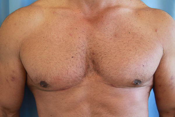 Gynecomastia Before and After | Dr. Leslie Stevens