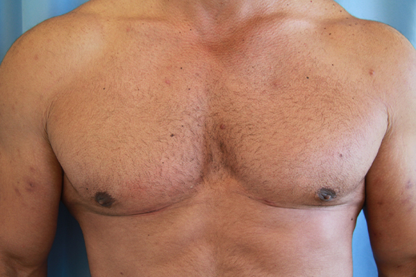 Gynecomastia Before and After 02