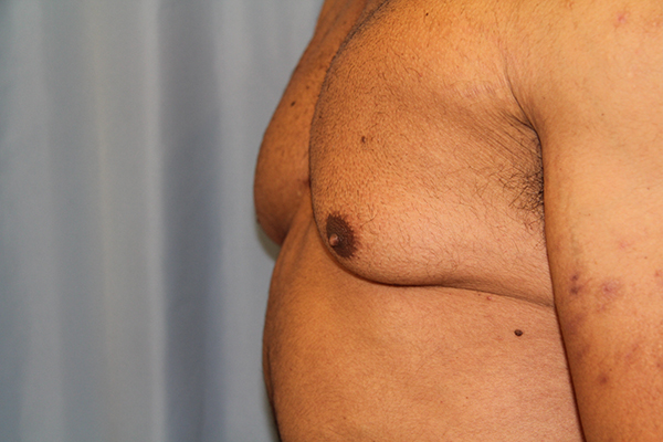 Gynecomastia Before and After 03