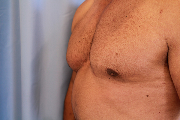 Gynecomastia Before and After 03