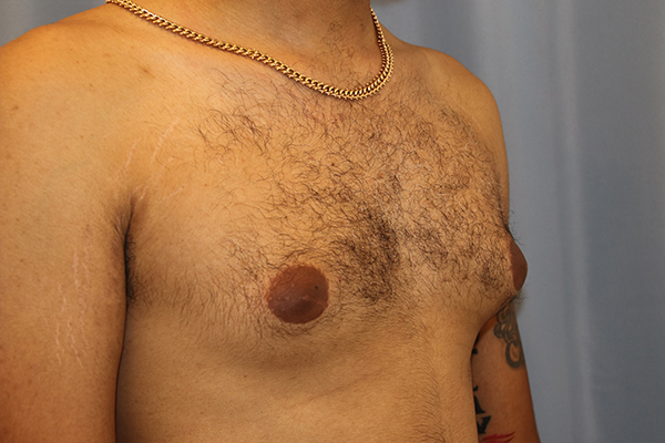 Gynecomastia Before and After 04