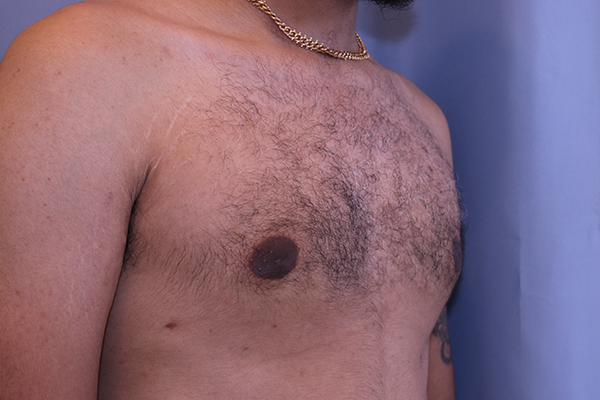 Gynecomastia Before and After 04