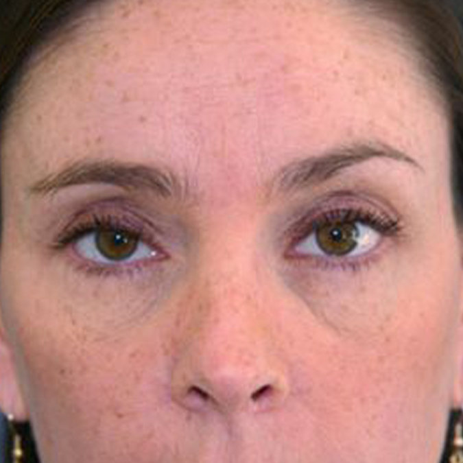Brow Lift Before and After | Dr. Leslie Stevens