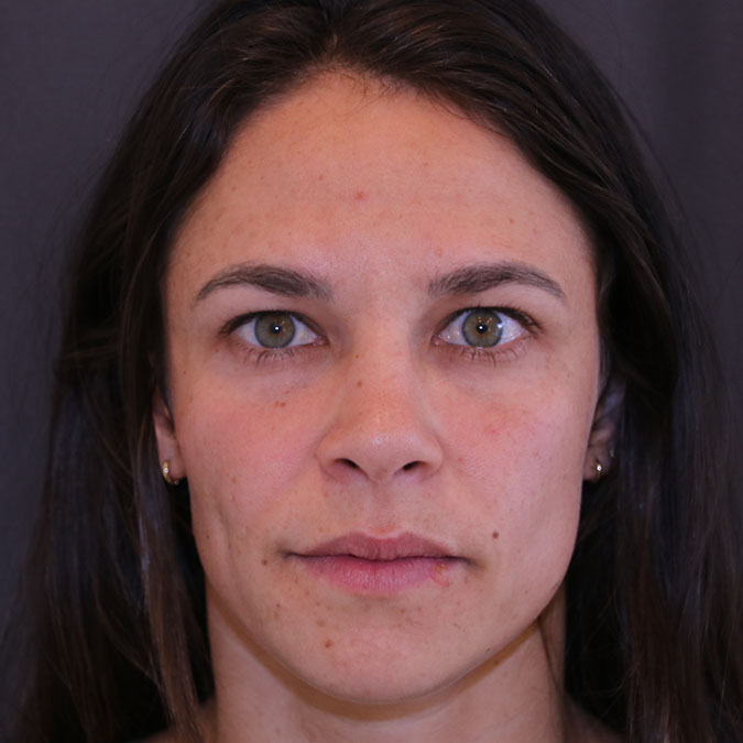 Brow Lift Before and After | Dr. Leslie Stevens