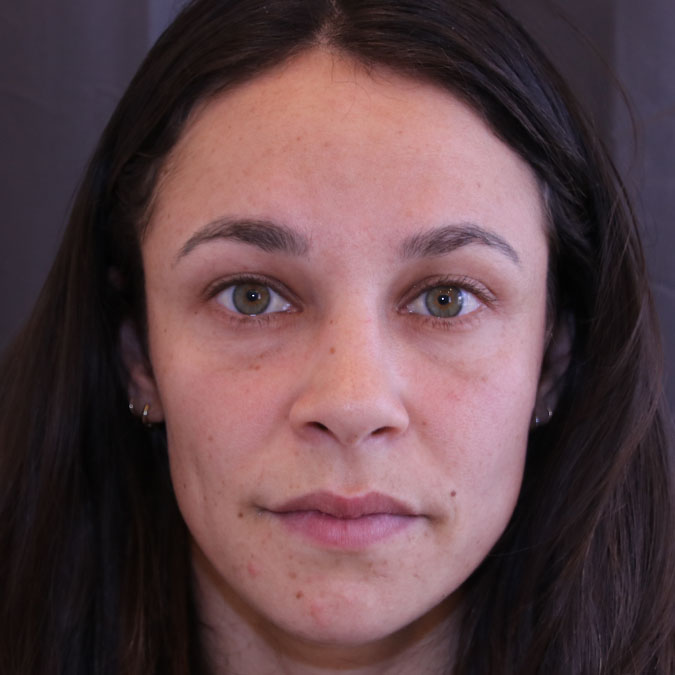 Brow Lift Before and After | Dr. Leslie Stevens