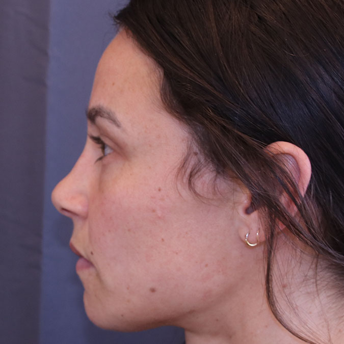 Brow Lift Before and After 04