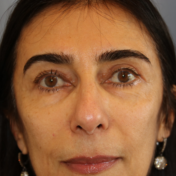 Eyelid Surgery Before and After 11