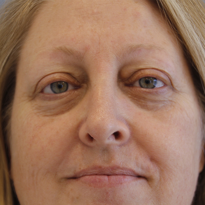 Eyelid Surgery Before and After 05