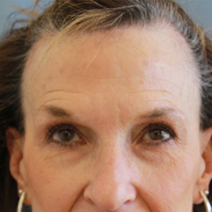 Eyelid Surgery Before and After | Dr. Leslie Stevens