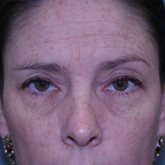 Eyelid Surgery Before and After | Dr. Leslie Stevens