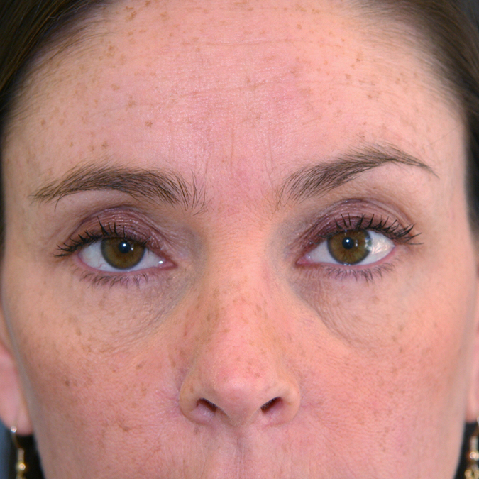 Eyelid Surgery Before and After 06