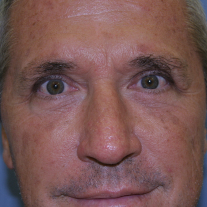 Eyelid Surgery Before and After 10
