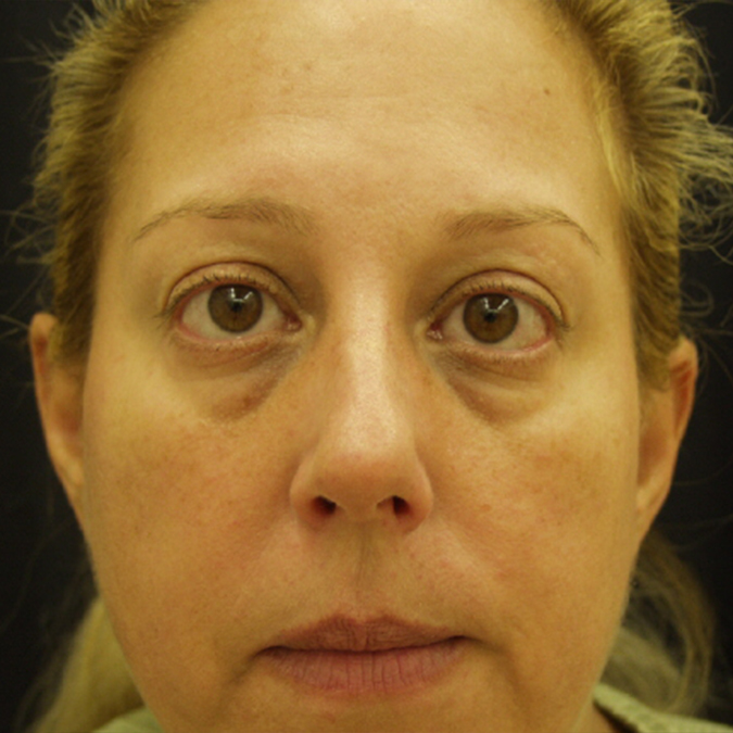 Eyelid Surgery Before and After | Dr. Leslie Stevens