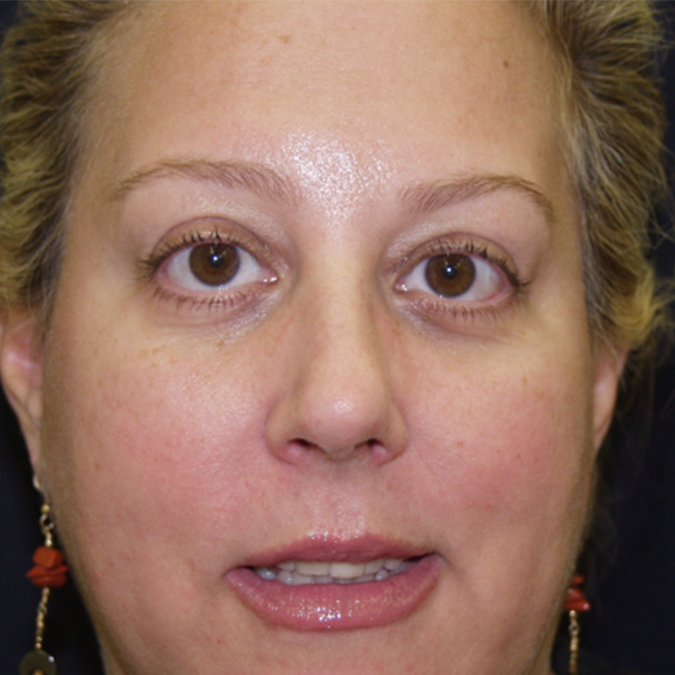 Eyelid Surgery Before and After | Dr. Leslie Stevens