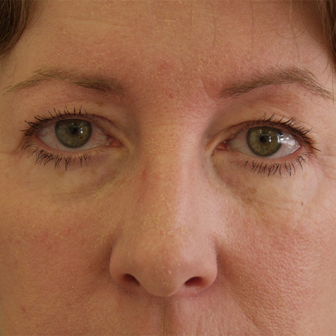 Eyelid Surgery Before and After | Dr. Leslie Stevens