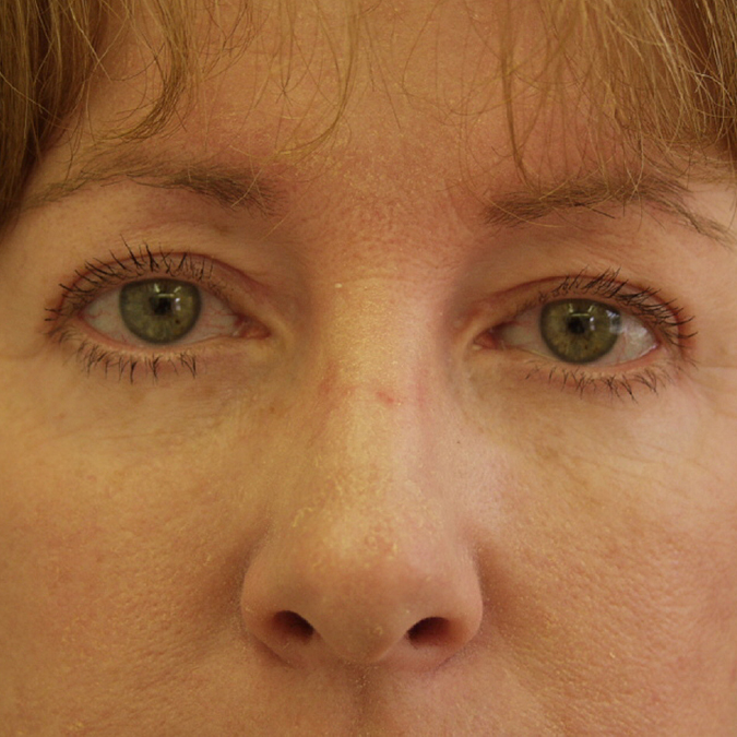 Eyelid Surgery Before and After 17