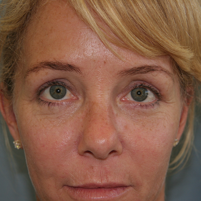Eyelid Surgery Before and After | Dr. Leslie Stevens
