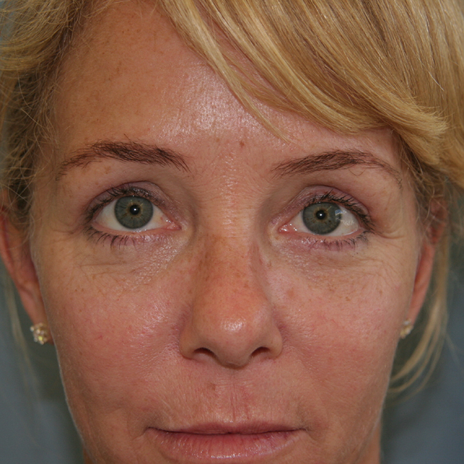 Eyelid Surgery Before and After 02