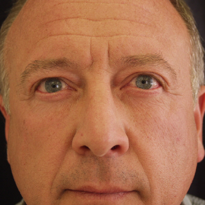 Eyelid Surgery Before and After | Dr. Leslie Stevens
