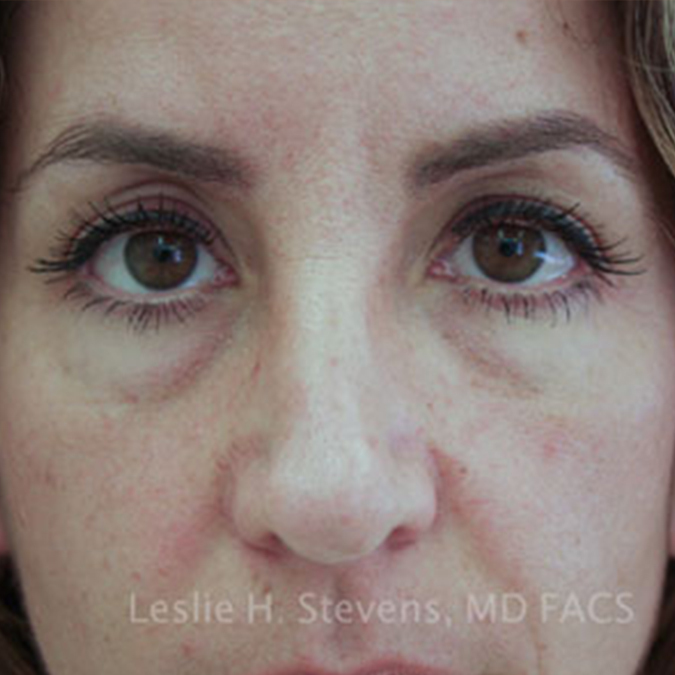 Eyelid Surgery Before and After | Dr. Leslie Stevens