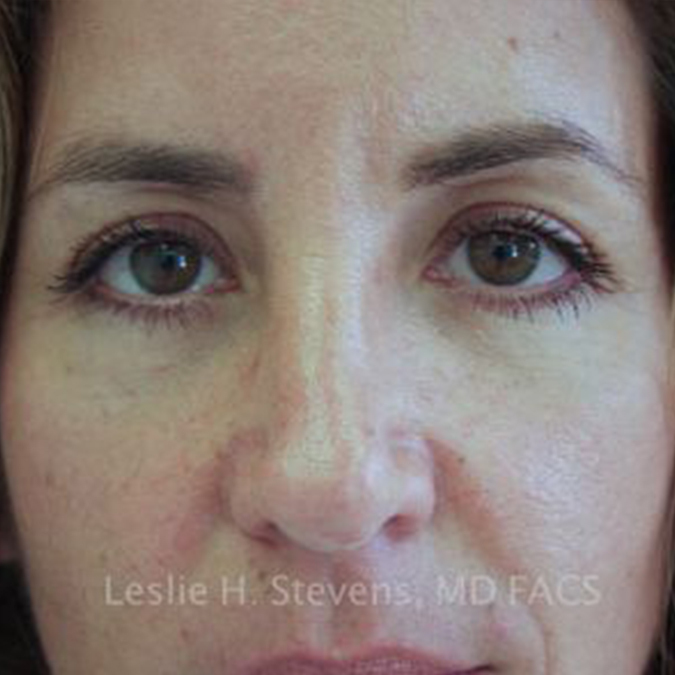 Eyelid Surgery Before and After | Dr. Leslie Stevens