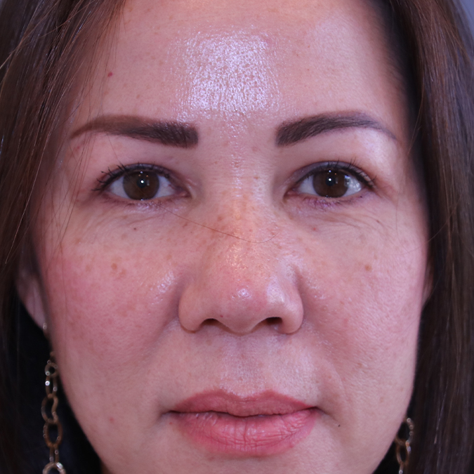 Eyelid Surgery Before and After | Dr. Leslie Stevens