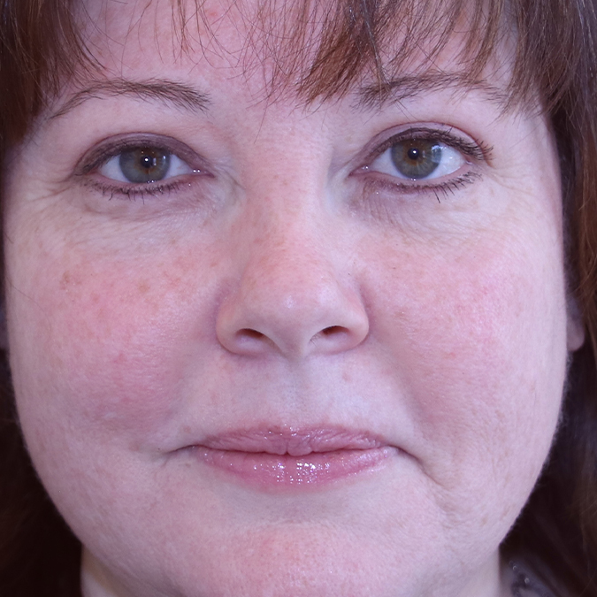 Eyelid Surgery Before and After | Dr. Leslie Stevens