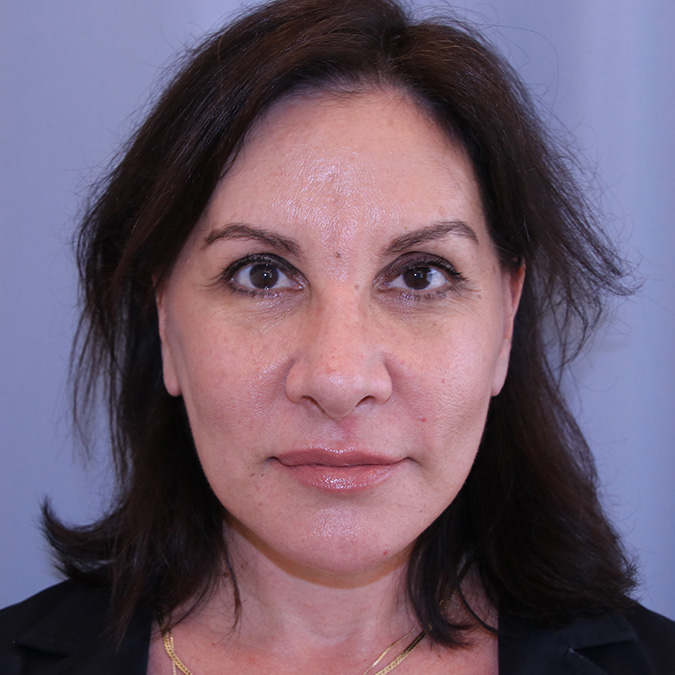 Facelift Before and After | Dr. Leslie Stevens
