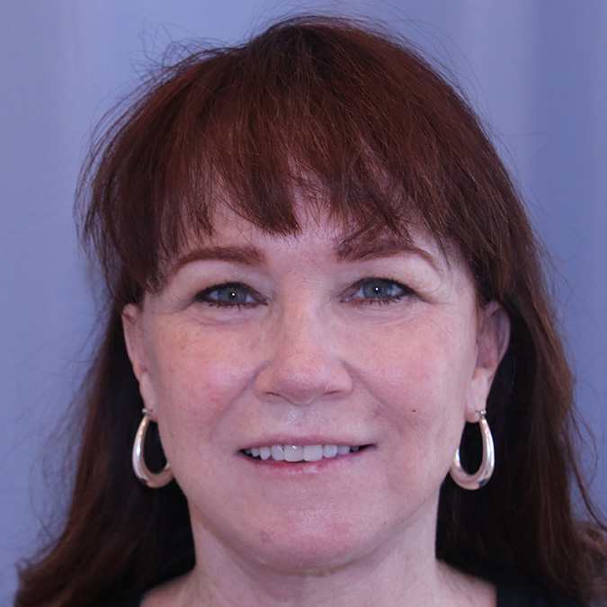 Facelift Before and After | Dr. Leslie Stevens