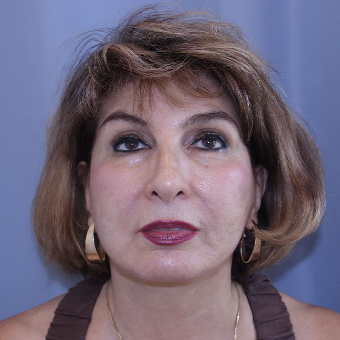 Facelift Before and After | Dr. Leslie Stevens