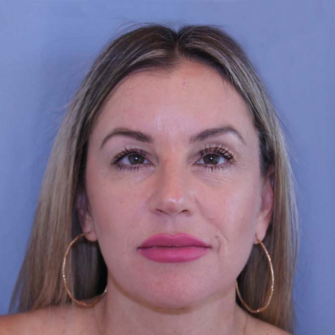 Facelift Before and After | Dr. Leslie Stevens