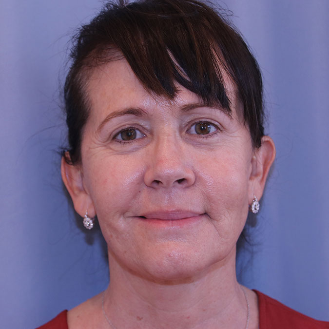 Facelift Before and After | Dr. Leslie Stevens
