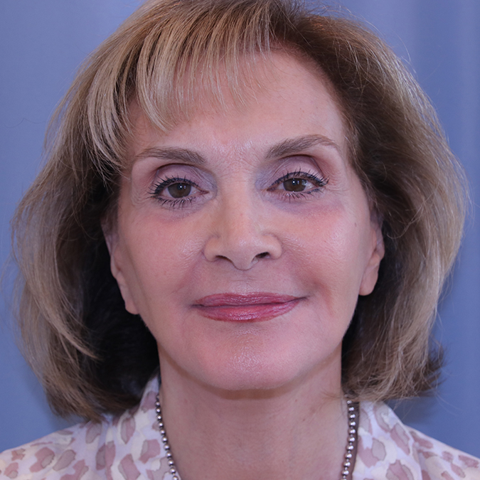 Facelift Before and After | Dr. Leslie Stevens